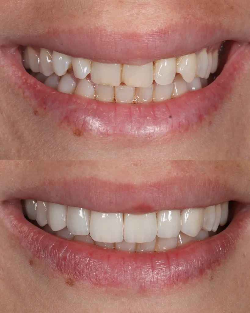 before after smile design