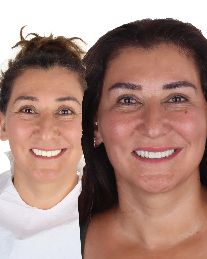 betül özden yüz