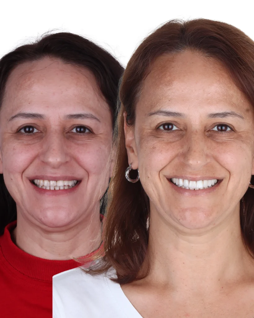 nalan sevinç yüz